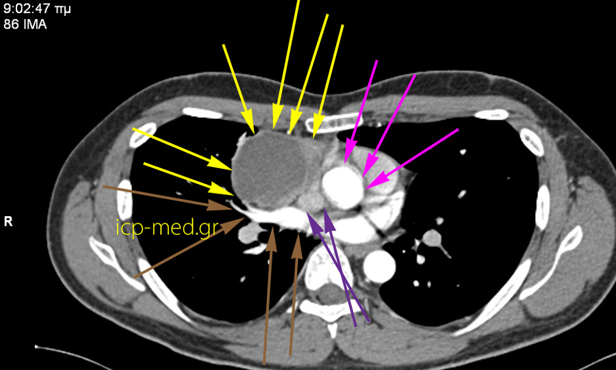 4.CT: Seminoma abuts Cavities of the heart (Right Atrium & Left Ventricle) & a right Pulmonary Vein
