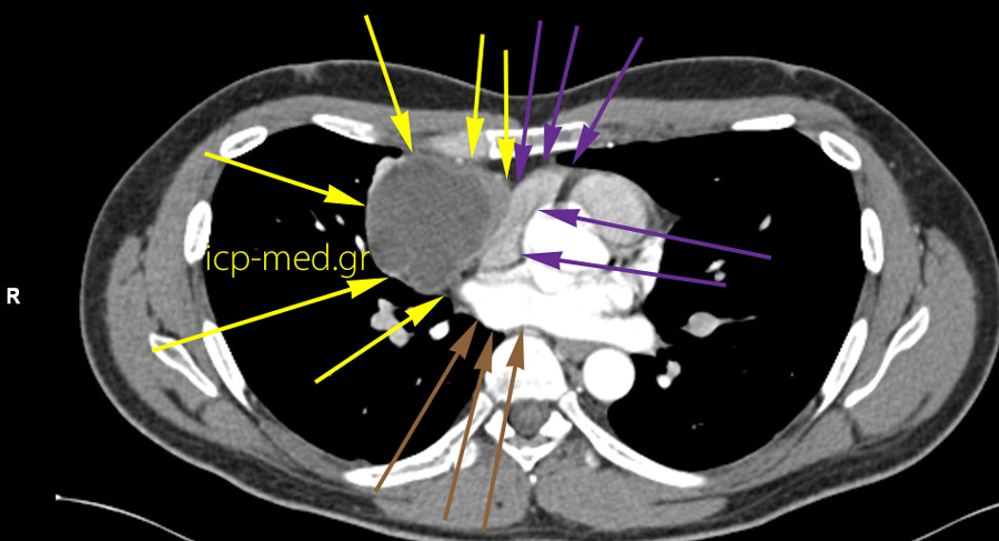 5.CT: Seminoma abuts the Rigt Atrium (cavity of heart) & a Pulmonary Vein