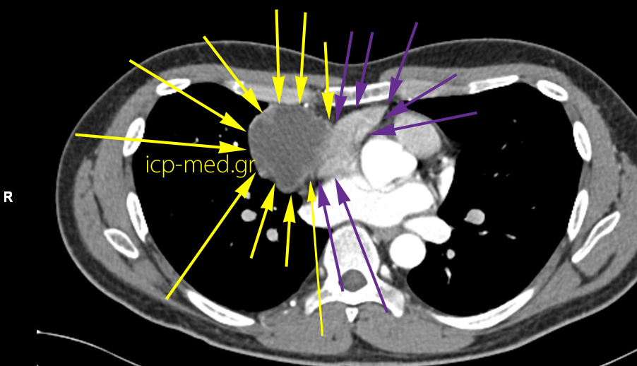 6.CT: Seminoma abuts teh Right Atrium (cavity of the heart)