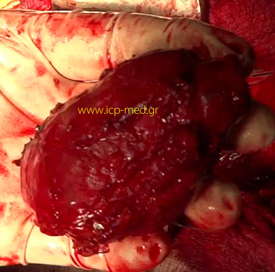 8.Specimen of Seminoma resected (size comparison against operator's fingers)