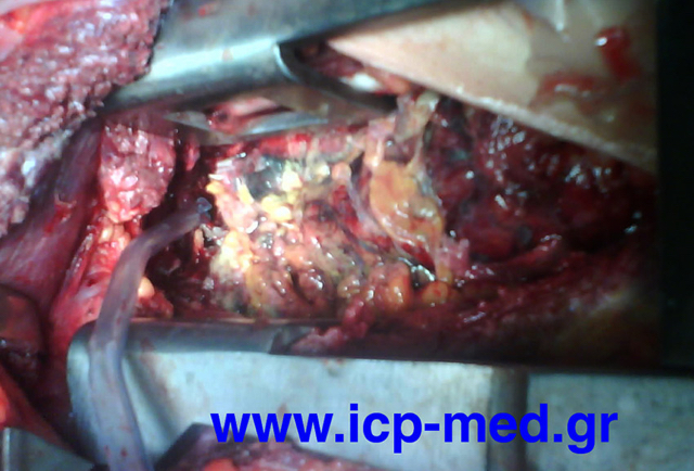 Gangrenous-looking appearance of tissues inside the left hemithorax