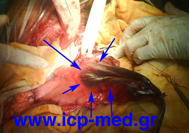 Clear margins of necrosis on stomach (arrows)