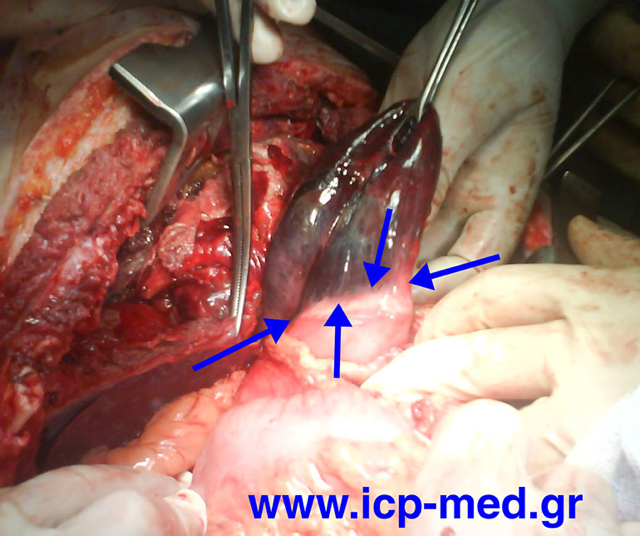 Clear margins of necrosis on stomach (arrows)