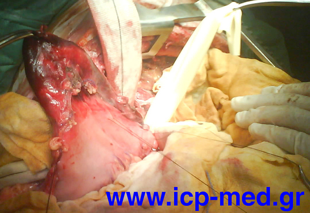 Residual part (viable) OF stomach, post resection of necrotic tissues