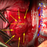 bronchogencyst3.jpg