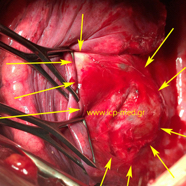 bronchogencyst2.jpg