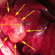 bronchogencyst1.jpg