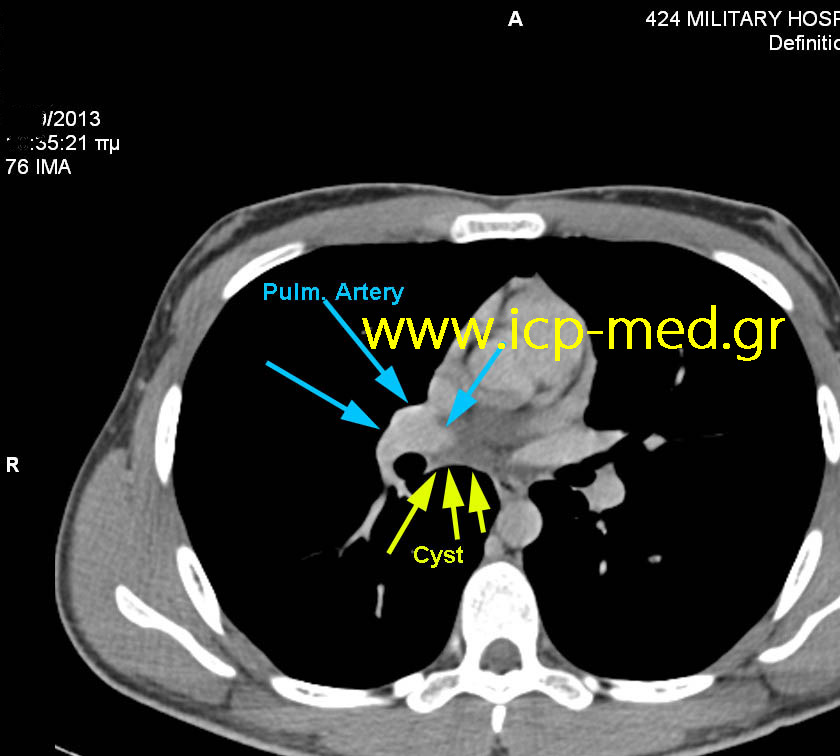 CT: Στενή ανατομική σχέση Κύστεως με ΔΕ Πνευμονική Αρτ. (ΓΑΛΑΖΙΑ)