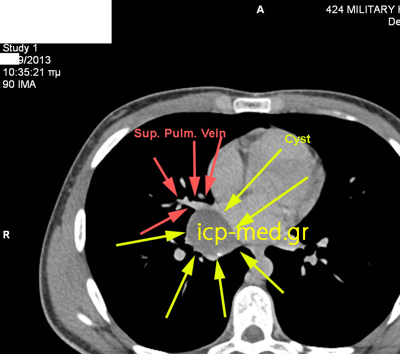 CT: Στενή ανατομική σχέση κύστεως με Άνω Πνευμονική Φλ (ΕΡΥΘΡΑ)
