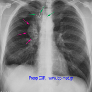 chestwallchondrosarcoma02.jpg