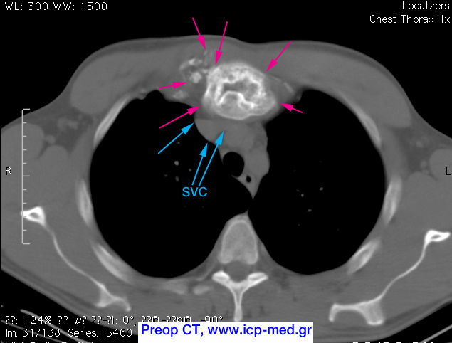 4. Προεγχ. CT. Ο όγκος (ιώδη βέλη) σε στενή ανατομική γειτνίαση με την Άνω Κοίλη Φλέβα (γαλάζια βέλη, SVC)