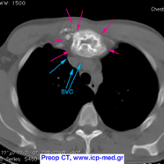 chestwallchondrosarcoma04.jpg