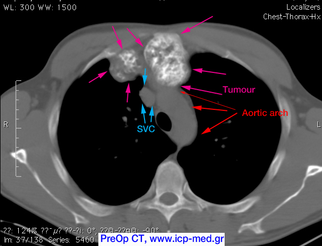 5. Προεγχ. CT. Ο όγκος (ιώδη βέλη) σε στενή ανατομική γειτνίαση με Ανιούσα Αορτή & Αορτικό Τόξο (κόκκινα βέλη)