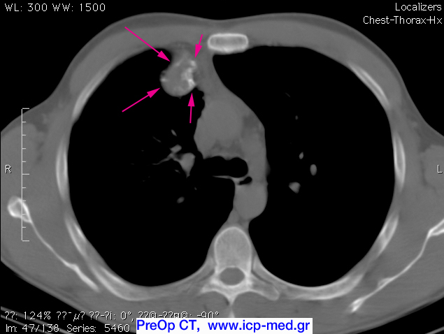 6. Προεχγ CT. Ο όγκος (ιώδη βέλη) επεκτείνεται κατά μήκος της 2ης δεξιάς πλευράς
