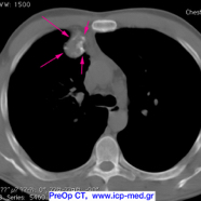 chestwallchondrosarcoma06.jpg