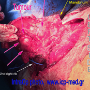 chestwallchondrosarcoma07.jpg