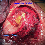 chestwallchondrosarcoma09.jpg