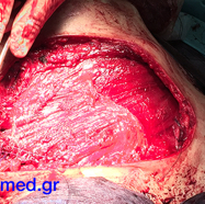 chestwallchondrosarcoma10.jpg