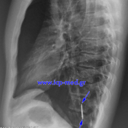 foreignbodlung04.jpg