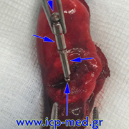 foreignbodlung07.jpg