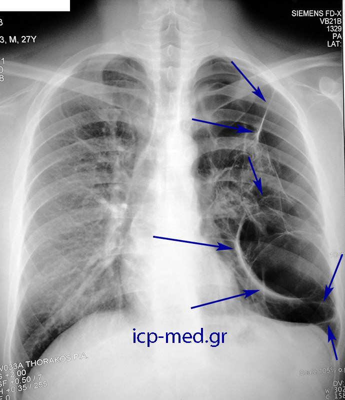7. Προεγχειρητική ακτ/φία θώρακος ίδιου ασθενούς (εικ. 2-11). ΜΠΛΕ: πολυάριθμες Ευμεγέθεις bullae
