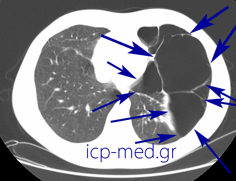 8. Προεγχειρητική CT ίδιου ασθενούς (εικ. 2-11). ΜΠΛΕ: πολυάριθμες Ευμεγέθεις bullae