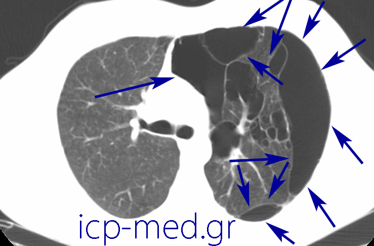 10. Προεγχ/κή CT ίδιου ασθενούς (εικ. 2-11). ΜΠΛΕ: πολυάριθμες Ευμεγέθεις bullae
