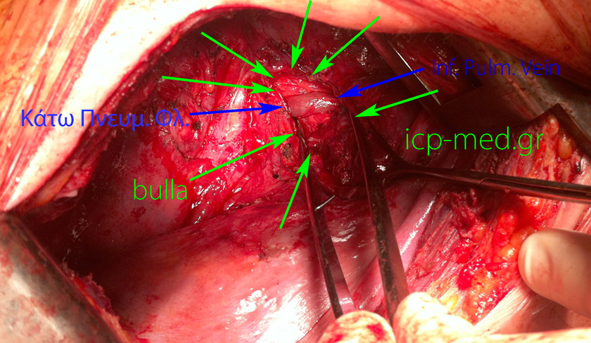 12. Η Κάτω Πνευμονική φλέβα (ΜΠΛΕ βέλη) αιωρείται στο εσωτερικό Μεγάλης bulla (ΠΡΑΣΙΝΑ), μ.δ. 7,8 cm