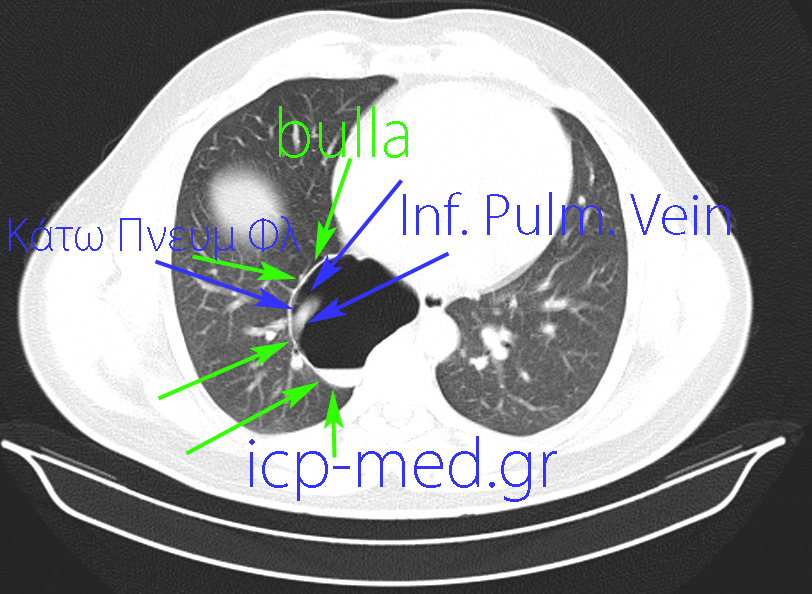 13. Προεγχειρητική CT: ΜΠΛΕ βέλη: η Κάτω Πνευμονική Φλέβα. ΠΡΑΣΙΝΑ: η αερώδης κύστη