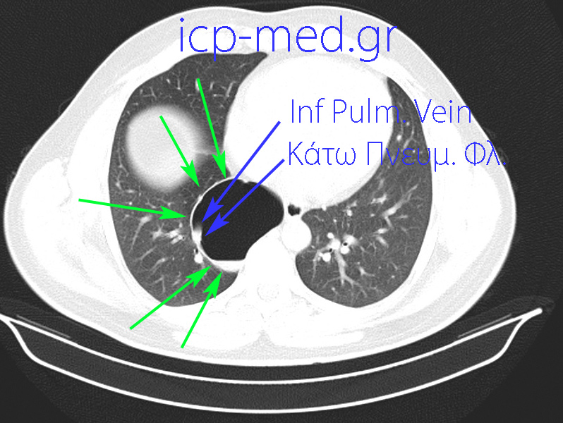 14. Προεγχειρητική CT: ΜΠΛΕ βέλη: η Κάτω Πνευμονική Φλέβα. ΠΡΑΣΙΝΑ: η αερώδης κύστη