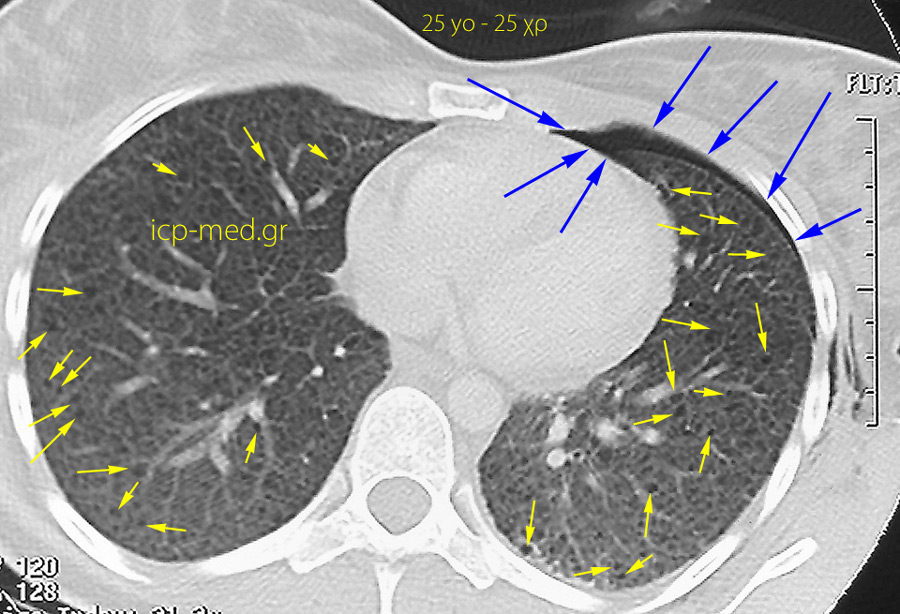 1. CT: πολυάριθμες αερ. Κύστεις (ΚΙΤΡ. βέλη) & Πνευμοθώρακας ΑΡ (ΜΠΛΕ). 25 χρ ♀