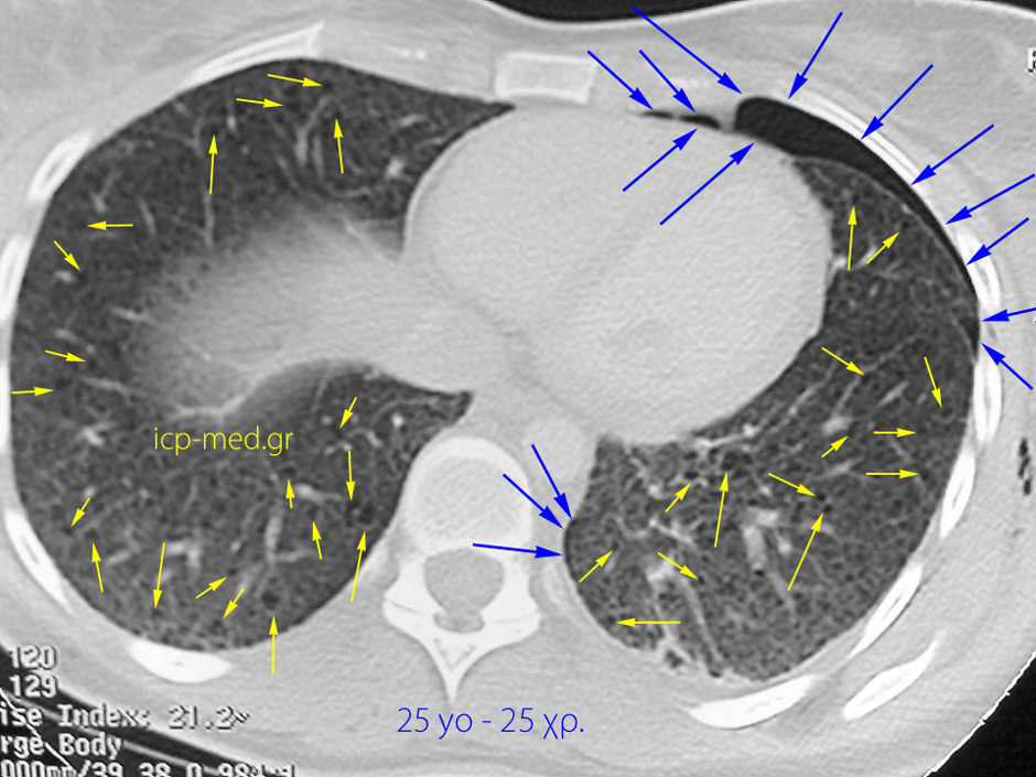2. CT: πολυάριθμ. αερ. Κύστεις, Πνευμοθώρακας ΑΡ & Υποδόριο Εμφύσημα. 25 χρ ♀