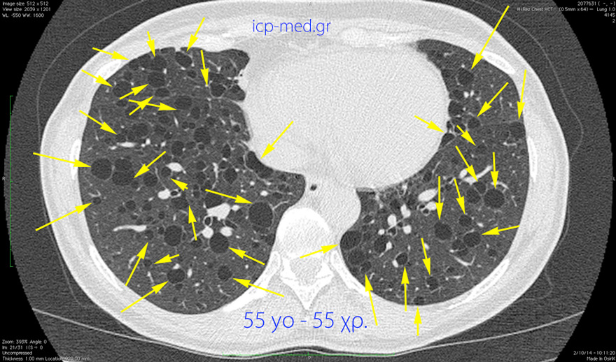 6. CT: πολυάριθμες Ευμεγέθεις αερ. Κύστεις σε 55 χρ. ♀