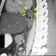 oesophagleiomyoma3.jpg