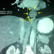 oesophagleiomyoma4.jpg