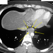 oesophagleiomyoma5.jpg