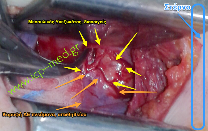 2. Απωθείται η δεξιά πνευμονική κορυφή (Πορτοκαλί) & εκτίθεται το Μεσαύλιο (Κίτρινο)