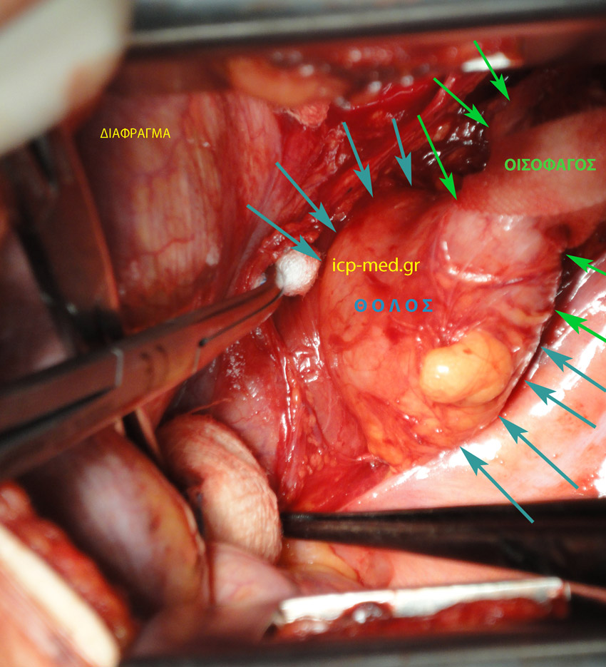 7. Διεγχειρητικά η Διαφραγματοκήλη, δηλ. ο ενδοθωρακικός θόλος στομάχου (ΜΠΛΕ). ΠΡΑΣΙΝΑ: οισοφάγος, ΚΙΤΡΙΝΑ: διάφραγμα
