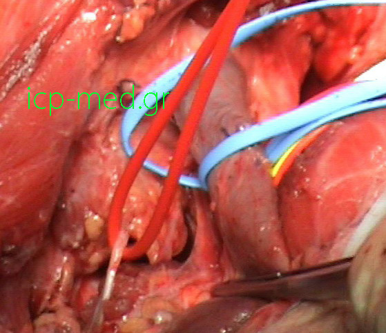 6. Μετά από εξαίρεση Όγκου. VESSEL LOOPS: Γαλάζιο: έσω σφαγίτιδα φλ., Κόκκινο: Φρενικό ν.