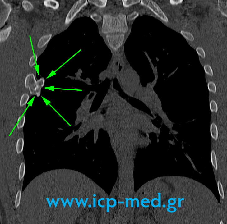 7. MRI προεγχειρ. (Στεφανιαία, Διφυής εδώ ο Όγκος)