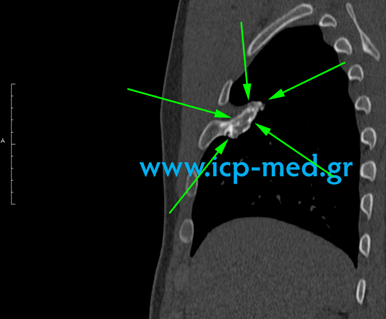 9. MRI προεγχειρ. (Οβελιαία)