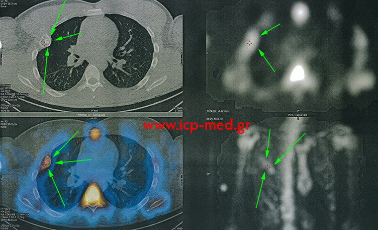 10. Υβριδική μελέτη SPECT / CT σπινθηρογραφική