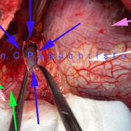 pericardialcyst03.jpg