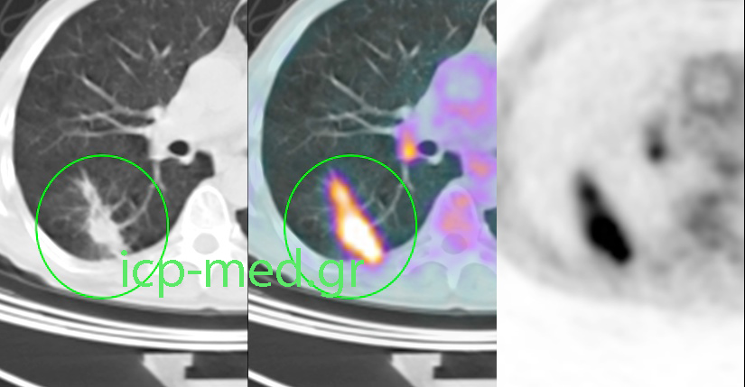 2. Προεγχειρητική PET/CT (αξονική όψη) Μάζας στον πνευμονικό ΔΚΛ με SUVmax 12 (μ.δ. 1,7 cm)