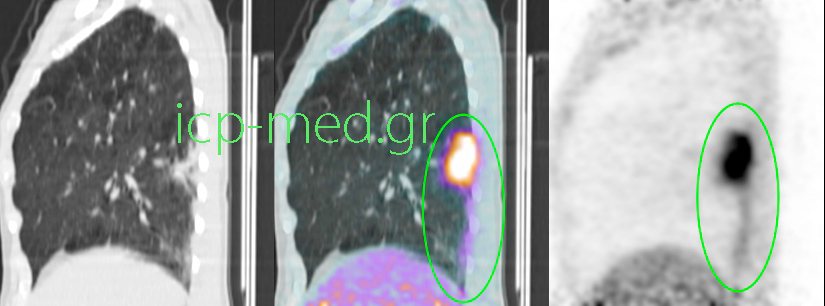 4. Προεγχειρητική PET/CT (οβελιαία όψη) Μάζας στον ΔΚΛ με SUVmax 12, λίαν ύποπτη για κακοήθεια