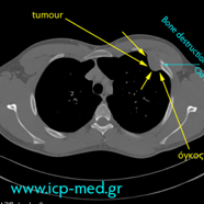 sarcomamyofibrobl04.jpg