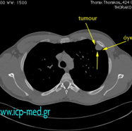 sarcomamyofibrobl05.jpg