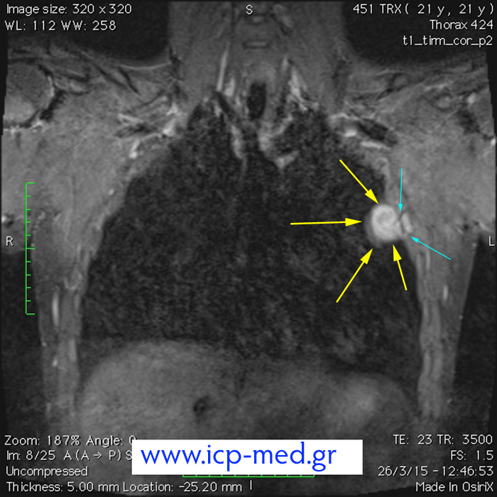 6. Προεγχ. MRI (στεφανιαία τομή· γαλάζια βέλη: σχέση Όγκου με 3η πλευρά)
