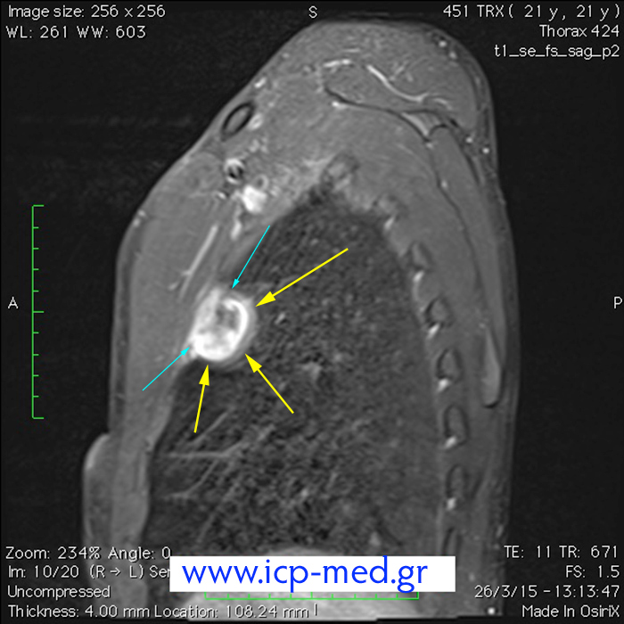 7. Προεγχ. MRI (οβελιαία τομή· γαλάζια βέλη: σχέση Όγκου με 3η πλευρά)