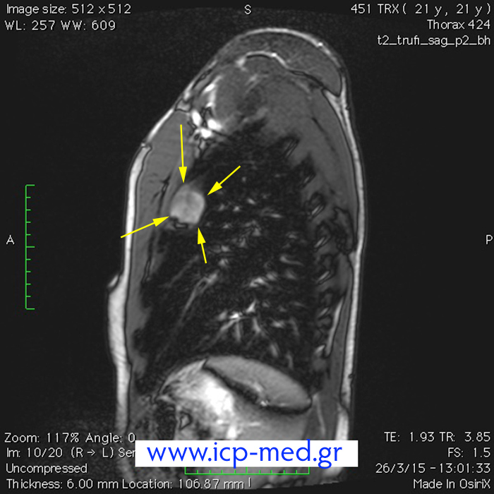 8. Προεγχειρητική MRI (οβελαία τομή)